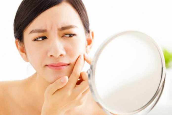 Simple Ways to Avoid Acne