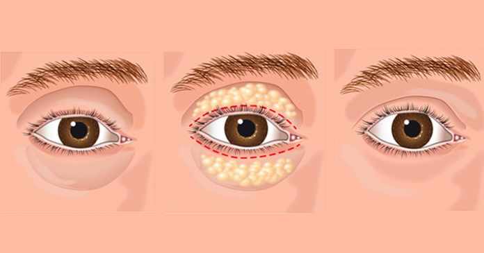 How to get rid of eye bags