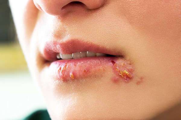 How to get rid of a cold sore?